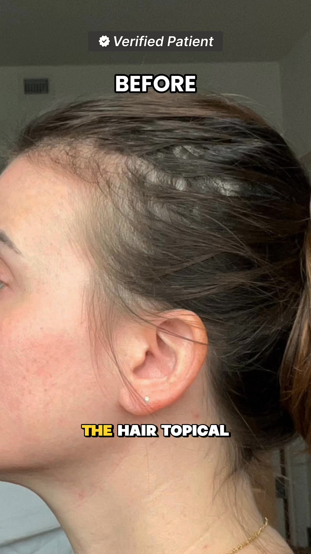 Thinning, shedding, or bald spots? They don’t have to be your normal ❤️ The Hair Topical Solution - Modern uses Nobel Prize-winning exosome technology to restore thicker, fuller, healthier hair. Join 